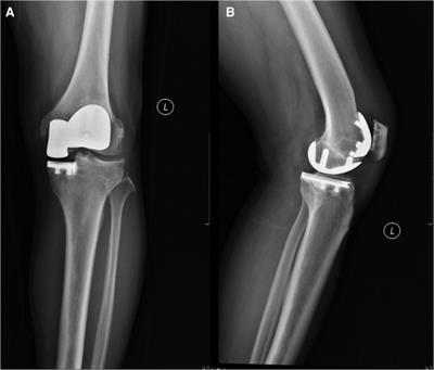 Better PROMs and higher return-to-sport rate after modular bicompartmental knee arthroplasty than after total knee arthroplasty for medial and patellofemoral compartment osteoarthritis